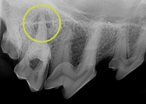 Röntgen des gleichen Patienten mit sichtbarer Entzündung an den Zahnwurzeln Karies und Zahnwurzelabszess